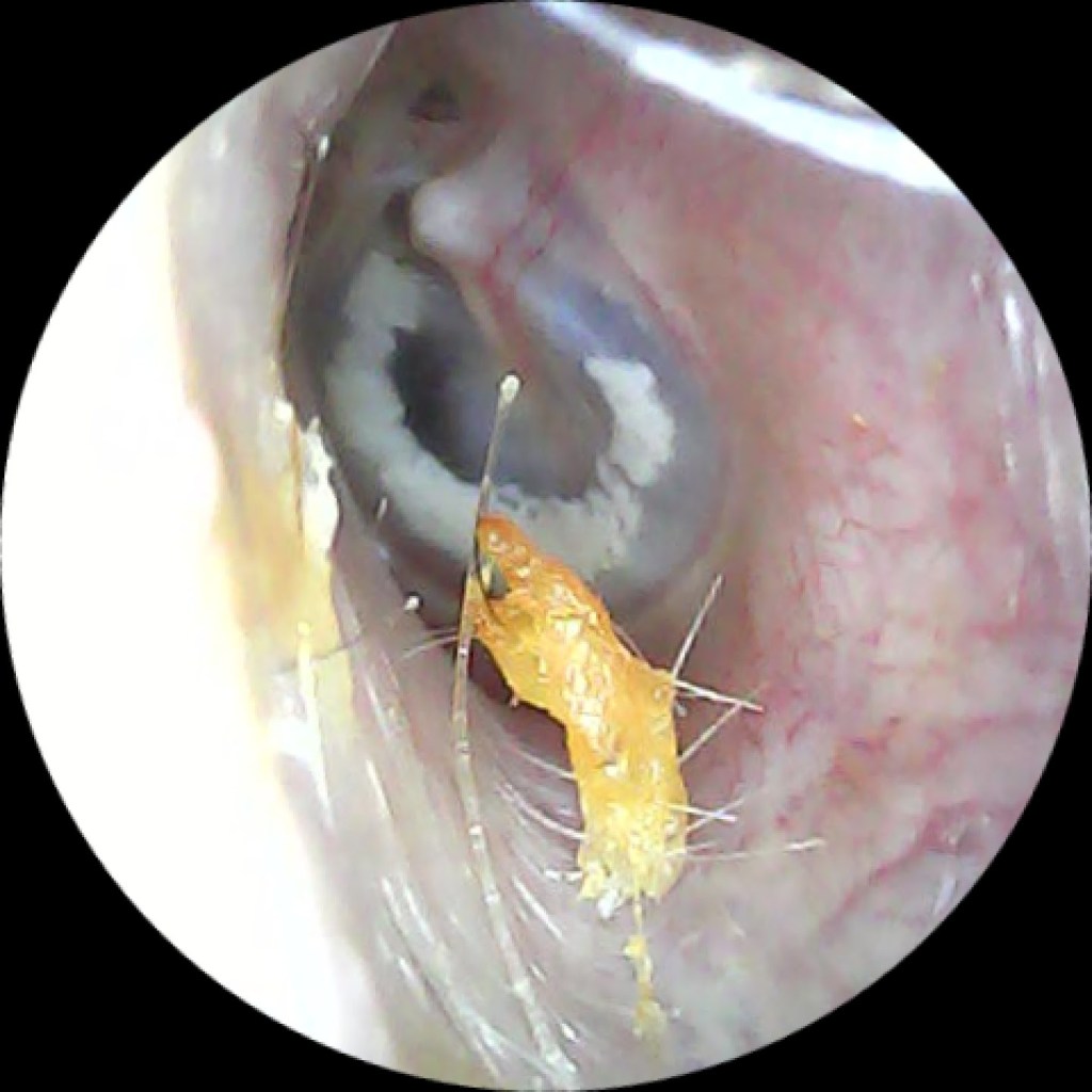 Timpanoesclerosis. Cortesia de Mi Aparato Auditivo