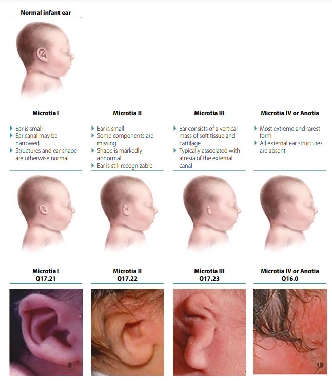 Congenial Example Auxiliares Auditivos de Conducción Ósea para Microtia – Mi Aparato Auditivo